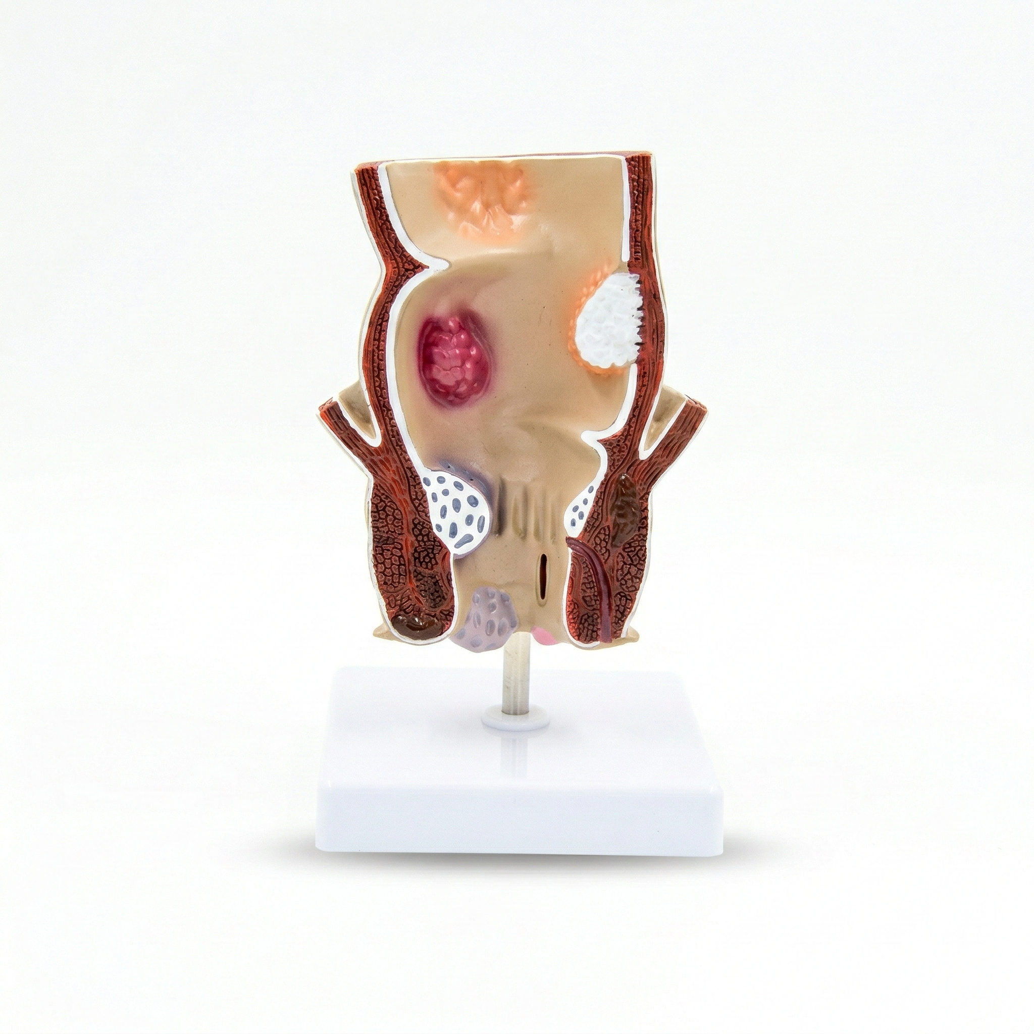 Modelo Patología Rectal